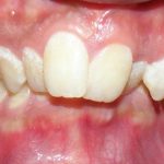 Deep Bite Malocclusion