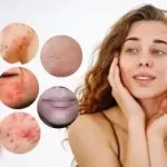 Advanced Acne Science & Aesthetic Skin Therapy Course