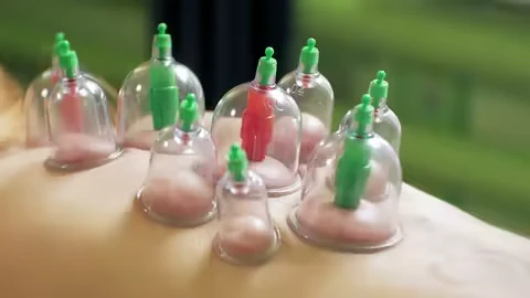 Advance Hijama Cupping Therapy Course Advance Hijama Cupping Therapy Course - Image 1