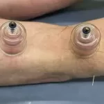 Professional Dry Cupping Therapy Course