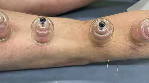 Professional Dry Cupping Therapy Course Professional Dry Cupping Therapy Course - Image 1